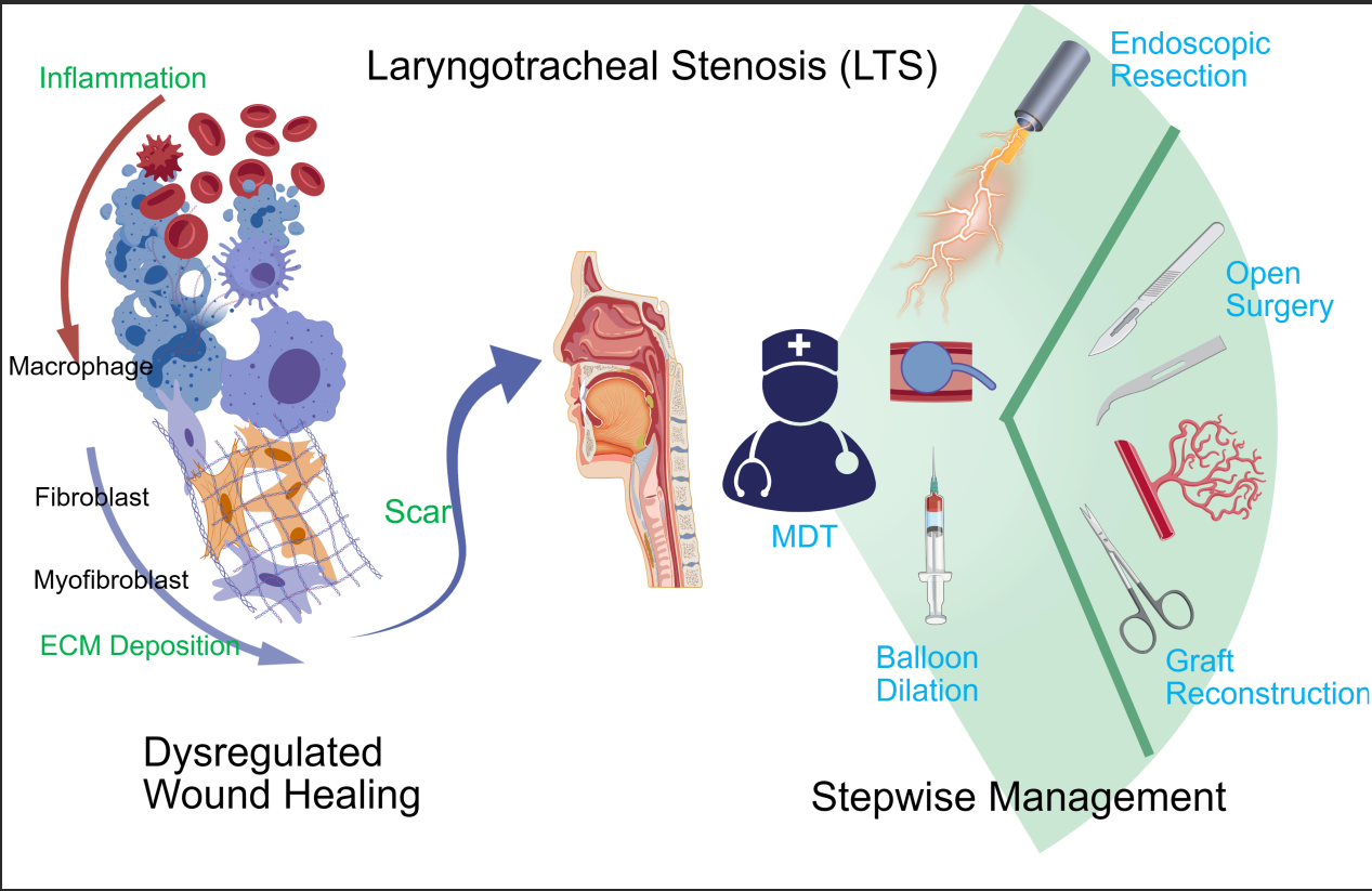 Advances in the Treatment of Laryngotracheal Stenosis