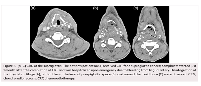 A Diagnostic Challenge: Risk Factors and Surgical Treatment of Laryngeal Chondroradionecrosis