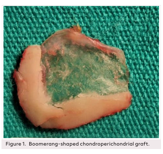 Tympanoplasty with Boomerang-Shaped Chondoperichondrial Graft: Long-Term Results