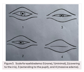 Effect of Total Intravenous Anesthesia and Inhalation Anesthesia on Edema and Ecchymosis in Rhinoplasty: A Prospective Randomized Clinical Trial