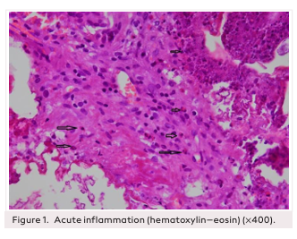Histopathological Examination of Cyanoacrylate Usage in Cartilage Graft Fixation