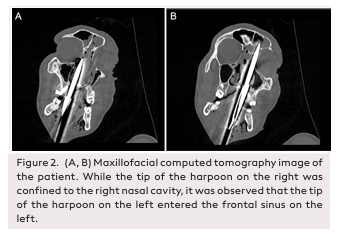 An Extraordinary Case of Maxillofacial Trauma: Injury by Harpoon Shot
