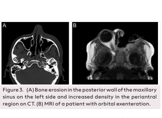 Acute Invasive Fulminant Fungal Rhinosinusitis: An Evaluation of 25 Cases