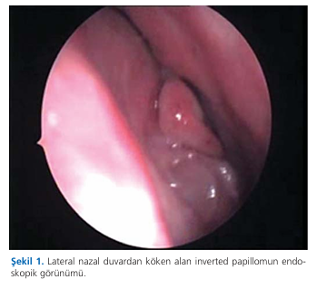 Our approach to sinonasal inverted papillomas