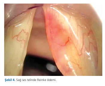 Benign vocal cord lesions and treatment update