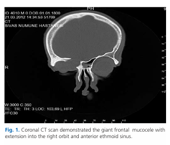Giant frontal pyomucocele