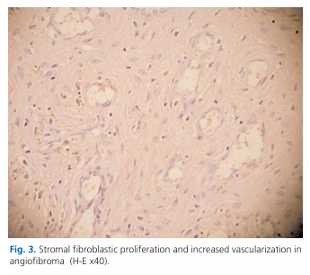 Extranasopharyngeal angiofibroma originating from sphenoid sinus: a case report