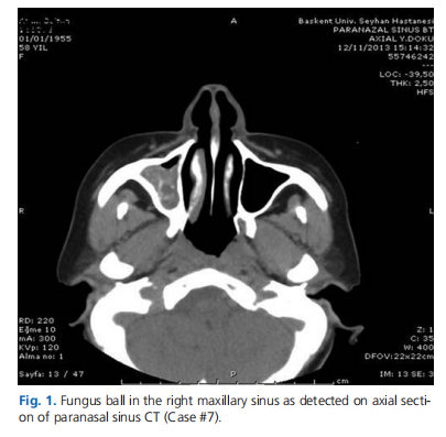 Our approach to cases with fungus balls of the paranasal sinuses
