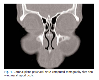 The effect of allergic rhinitis on nasal septal body size