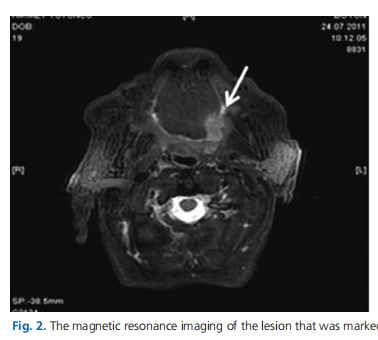 Primary adenocarcinoma of the base of tongue: a rare case
