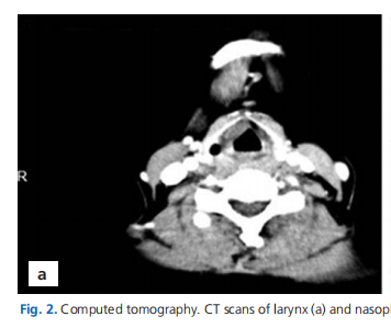 Otolaryngological findings in mucopolysaccharidosis