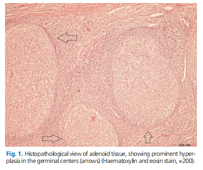 Identification of the immune receptor CD14 in hypertrophic adenoids