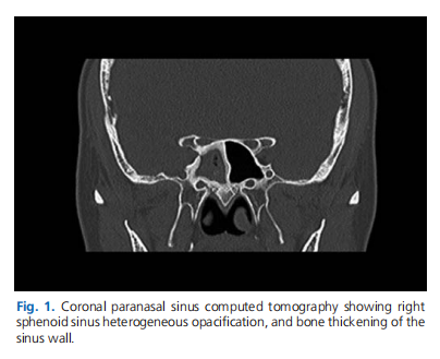 Paranasal sinus fungus ball: analysis of clinical characteristics and surgical outcomes