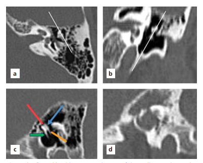 Which temporal bone anatomical structures and pathologies could be best visualized by applying reconstruction to cross-sections obtained on an axial plane?