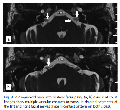 Evaluation of the vascular contacts of the facial nerve on three-dimensional fast imaging employing steady-state acquisition MRI in Bell&rsquo;s palsy