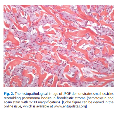 Juvenile psammomatoid ossifying fibroma with skull base and orbital wall invasion: a rare case report*