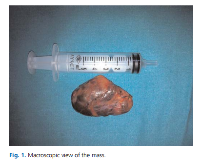 Bilateral and multicentric Warthin&rsquo;s tumor primarily presented with cervical lymph node involvement