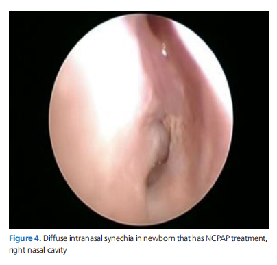 Nasal Complications Related With Cpap Treatment