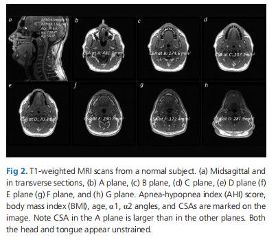 Postural Mechanisms That Maintain Airway Adequacy In Obstructive Sleep Apnoea As Determined By Magnetic Resonance Imaging