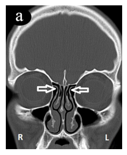 The relationship between superior attachment of the uncinate process of the ethmoid and varying paranasal sinus anatomy: an analysis using computerised tomography