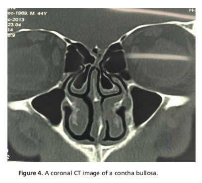 Computed Tomographic Findings in the Nasal and Paranasal Sinuses of Patients Scheduled for Rhinoplasty at Mostafa Khomeini Hospital between 2011-13