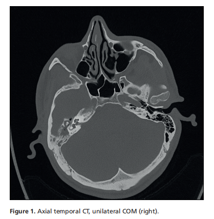 Possible Effects of Chronic Otitis Media with and without Cholesteatoma on Bone Conduction Thresholds: An Evaluation of 112 Cases