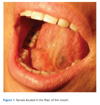 Retrospective analysis of ranula patients managed with surgical treatment