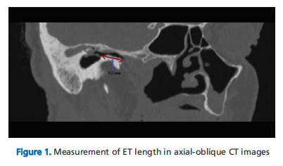 Relationship between Eustachian Tube Dimensions and Middle Ear Cholesteatoma