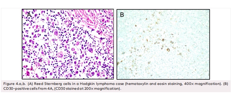 A Clinicopathological Evaluation of the Patients with Supraclavicular Lymphadenopathy: A Retrospective Analysis