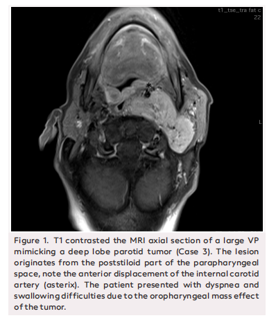 An Overview of Vagal Paraganglioma Surgery: Evaluation of Operative Morbidities and Quality of Life After Surgery
