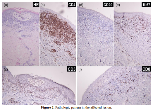 Topical potent corticosteroids and R-CDOP improved mycosis fungoides after 20 years treatment as tinea corporis