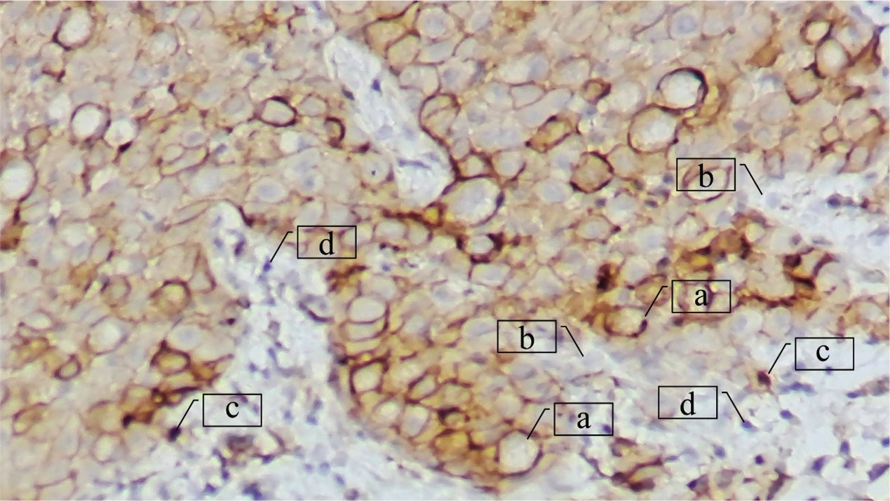 Frequency and clinicopathologic associations of microsatellite instability and PD-L1 expression in Vietnamese patients with gastric cancer