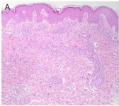 A pediatric case of exudative erythema multiforme probably associated with asymptomatic COVID-19