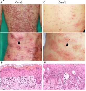 Two cases of COVID-19 vaccine-related erythema multiforme under the administration of immune checkpoint inhibitors