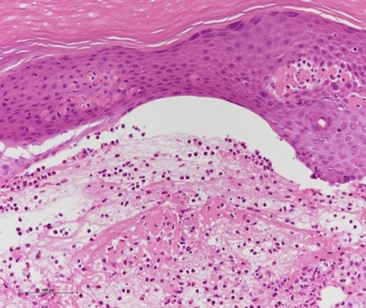 Mucous membrane pemphigoid involving palmoplantar lesions that developed during adjuvant nivolumab for malignant melanoma: A rare case and literature review