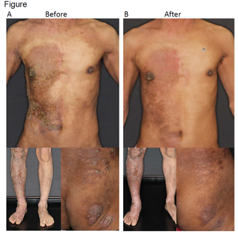 A case of unilateral epidermal nevi complicated by atopic dermatitis treated with dupilumab